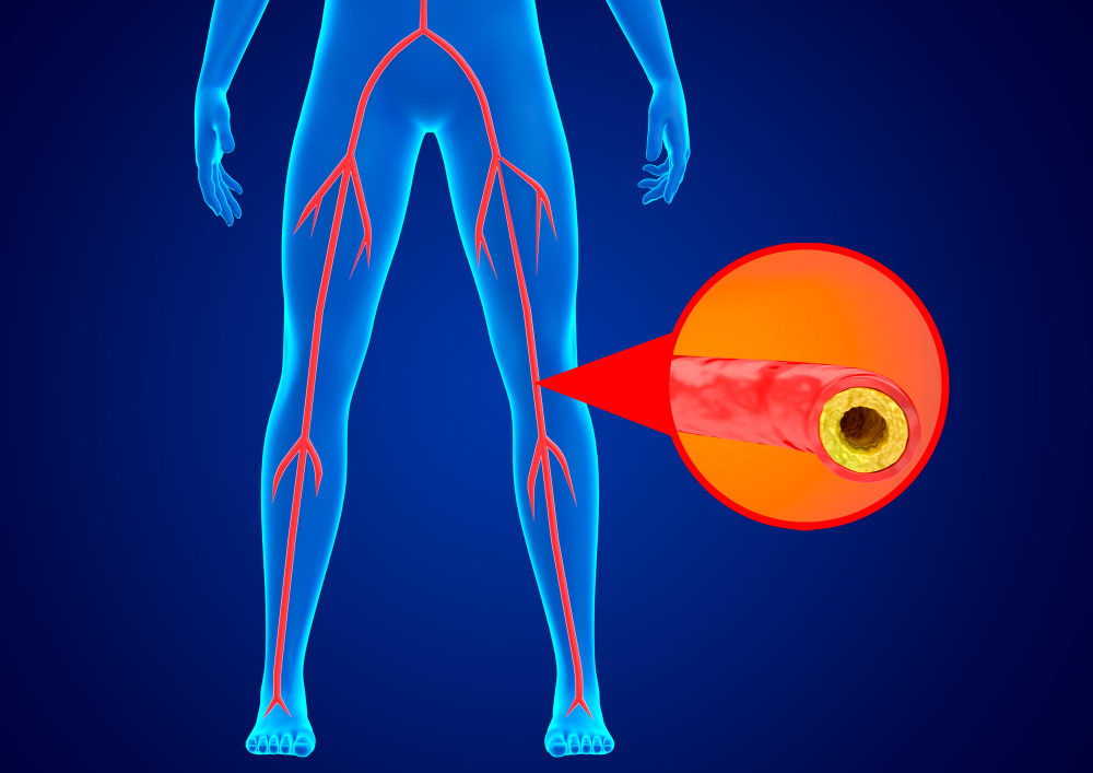 peripheral arterial disease is accumulation fat calcium walls arteries lower limbs preventing blood flow